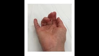 Hand injuries rehabilitation and timeframes [upl. by Ahsimek620]