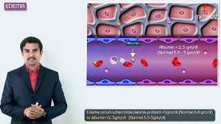 1Edema introduction  Hemodynamic pathology Fmge Neet PG and usmle [upl. by Tager901]