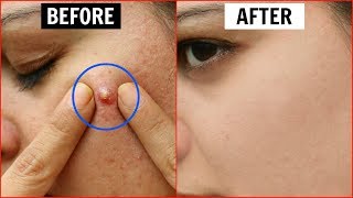 एक ही रात में Pimples हो जाएंगे गायब  Remove Pimples Overnight  Anaysa [upl. by Curtice]