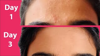 ACNE Treatment At Home  3 day Acne REMOVAL Challenge  Acne Treatment Ayurvedic with Results [upl. by Okihcas879]