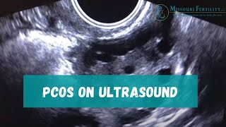 PCOS Sonogram and Discussion [upl. by Plato344]