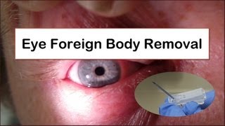 Eye Foreign Body Removal [upl. by Ravert]