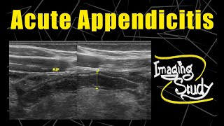 Acute Appendicitis  Ultrasound  Case 104 [upl. by Heymann]