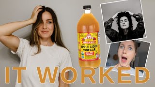 30 DAY CHALLENGE  Apple Cider Vinegar Hair Rinse  SHOCKED [upl. by Onileva185]