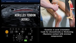 Ultrasound Tutorial MSK Series Achilles Tendon  Radiology Nation [upl. by Esinel]