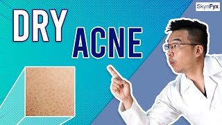 How To Treat Dry Skin  Acne Dry Acne  5 Tips To Follow [upl. by Elwyn]