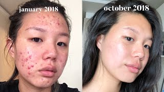 How to Prevent Acne Breakouts [upl. by Ayahc]