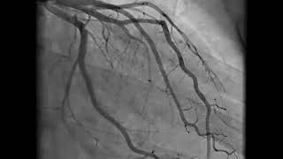 Coronary Angiography  NEJM [upl. by Derej]