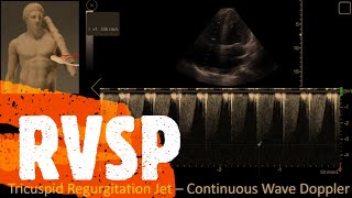 Estimate the RVSP Right Ventricular Systolic Pressure or PASP Perioperative amp Critical Care POCUS [upl. by Aehsan]