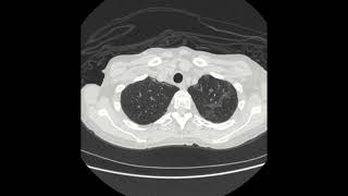 Pulmonary Nocardiosis [upl. by Nudnarb351]