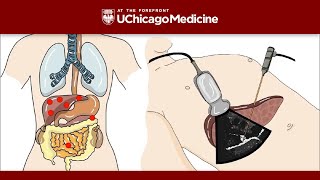 Neuroendocrine Tumor  Appendix  Histopathology [upl. by Lamont]