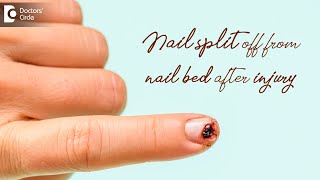 Nail split off from nail bed after injury  Tips by Dermatologist Dr Nischal K Doctors Circle [upl. by Lyndes]