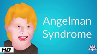 What does Angelman Syndrome look like [upl. by Mintun]