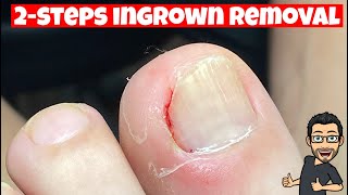 HOW TO REMOVE AN INGROWN TOENAIL [upl. by Noyes414]