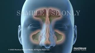 Sinusitis Surgery [upl. by Eki]