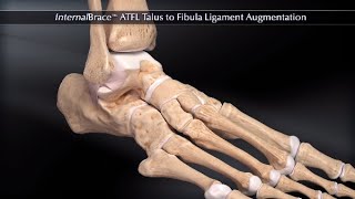 Dislocating Knee Cap Surgery  MPFL Reconstruction [upl. by Eedeed130]