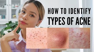 How to treat EVERY type of acne With Pictures [upl. by Yditsahc]