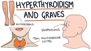 Managing a Thyroid Mass The Patient Experience [upl. by Britton]