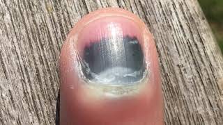 Fingernail Time Lapse 4 Month Recovery [upl. by Seraphine]