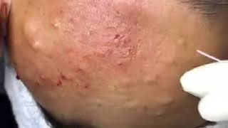 SUPER Removal of Cyst Acne on the Forehead at HIỀN VÂN SPA  Part 3  TRỊ MỤN HIỆU [upl. by Eelytsirk]