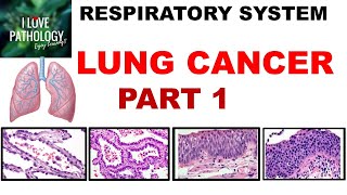 Lung Neuroendocrine Tumors Treatment with Robert Ramirez OD [upl. by Suzie]