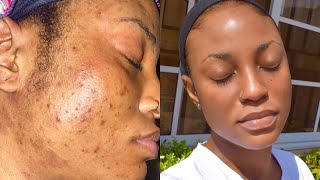 SKINCARE ROUTINE FOR OILY ACNE PRONE SENSITIVE SKIN  How I deal with Hyper Pigmentation amp Texture [upl. by Wurster]