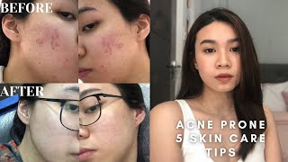 5 Skin Care Tips For Acne ProneOilySensitive Skin  Andy Buela Philippines [upl. by Chatav151]