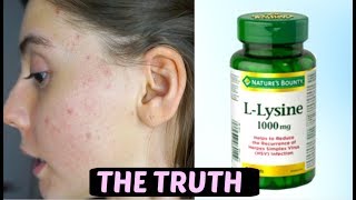 I TOOK LYSINE FOR 2 WEEKS STRAIGHT THIS IS WHAT HAPPENED TO ACNE SCARS [upl. by Yatzeck338]