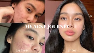 How I Cleared my Acne somehow PHILIPPINES  Lj Torres [upl. by Ohcamac]