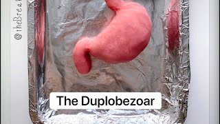 Playdough Surgery  Bezoar Removal [upl. by Eanad]