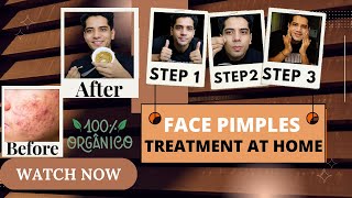 Face Pimples Treatment At Home  ACNE TREATMENT  Pimples Kese Hataye  shivammalik [upl. by Lehar]