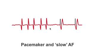 Pacemakers and slow AF patients [upl. by Sigismondo978]