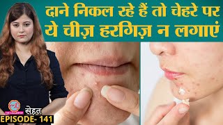 Acne Pimples दानों को बिना निशान ठीक करना है तो ये गलतियां ना करें  Sehat ep 141 [upl. by Eiddet]