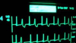 intensive care ecg with extrasystoles [upl. by Palmore434]