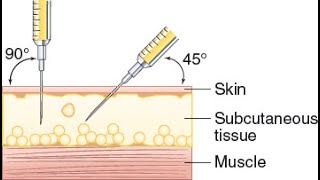 Subcutaneous Injection Demonstration [upl. by Erasmus]