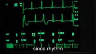 extrasystoles ventricular bigeminus [upl. by Frederic]