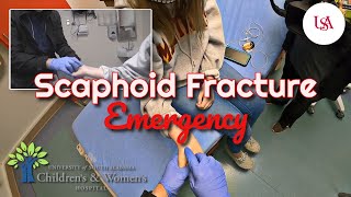 Scaphoid Bone Fracture Emergency [upl. by Olrak]