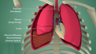 Pleural effusion  Internal medicine Etiology Clinical Features Diagnosis and Treatment Usmle [upl. by Firahs744]