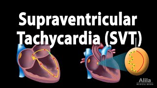 Supraventricular Tachycardia SVT PSVT Animation [upl. by Acenahs]