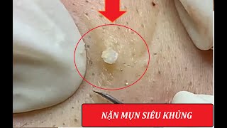 Giant blackheads amp Severe cystic acne squeezed 4  Loan Nguyen [upl. by Akcimat246]