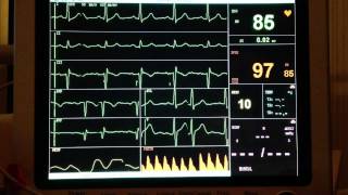 ECG  Extrasystole [upl. by Eeleimaj]