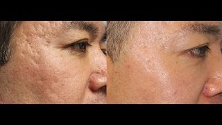 Amazing Laser Acne Scar Removal Results [upl. by Aiva]