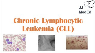 Chronic Lymphocytic Leukemia CLL Symptoms ex Skin Blisters Diagnosis and Treatment Vit D [upl. by Retswerb]