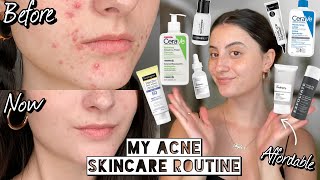 How I Cleared My HORMONAL ACNE amp SCARRING with Affordable Skincare  Dry amp Sensitive Skin [upl. by Kiele]