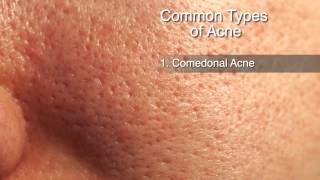 Acne Treatment Options [upl. by Anhoj]