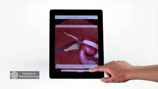 Touch Surgery Simulation  Laparoscopic Appendectomy [upl. by Jago]