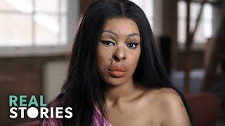 ACID ATTACK My Story Crime Documentary  Real Stories [upl. by Inele]