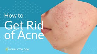 Acne Treatment  Explained by Dermatologist [upl. by Cowie]