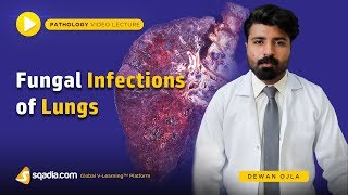 Fungal Infections of Lungs  Actinomycosis Histoplasmosis Coccidioidomycosis  Introduction [upl. by Nyad]