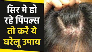 सिर में हो रहे हैं पिंप्लस तो ये घरेलू नुस्खे आएंगे काम  Scalp Pimples Home Remedies  Boldsky [upl. by Iru]